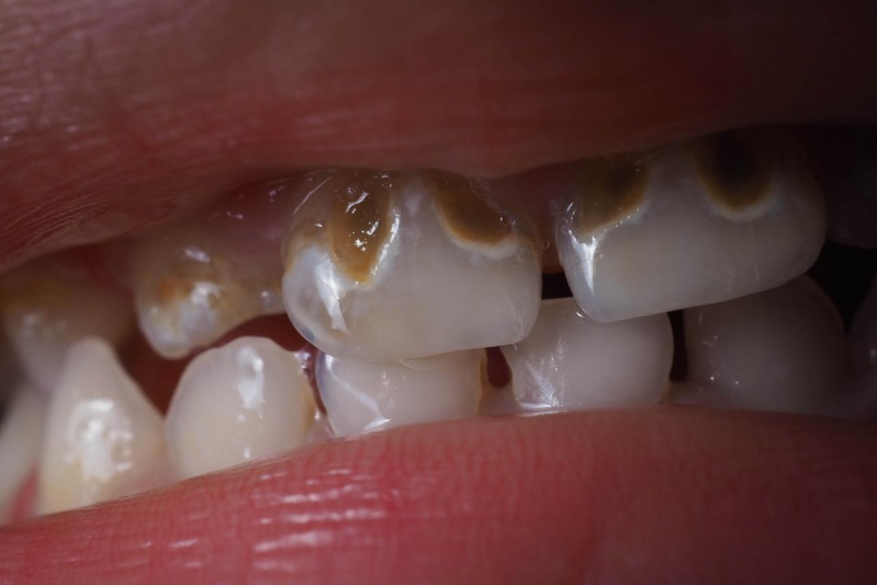 Sbiancamento Denti Milano | Studio Chirico Tolardo