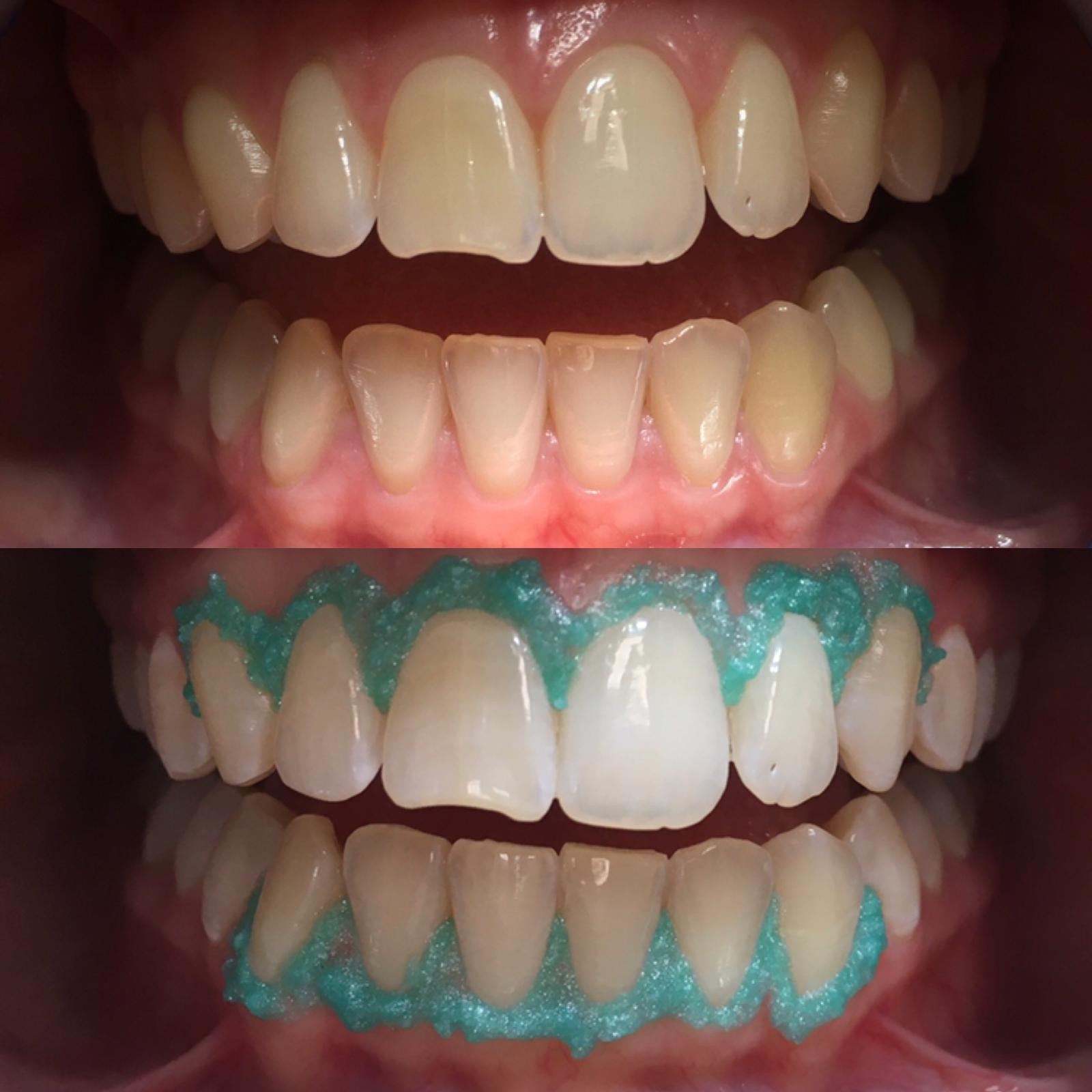 Sbiancamento Denti Milano | Studio Chirico Tolardo